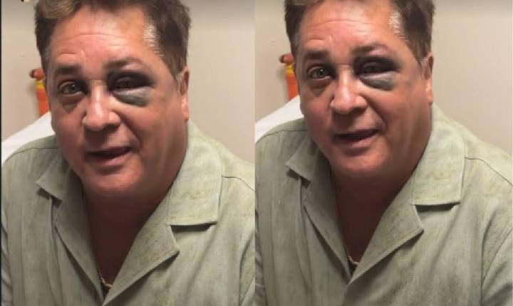 Leonardo surge com o olho roxo após acidente. Saiba o que aconteceu!