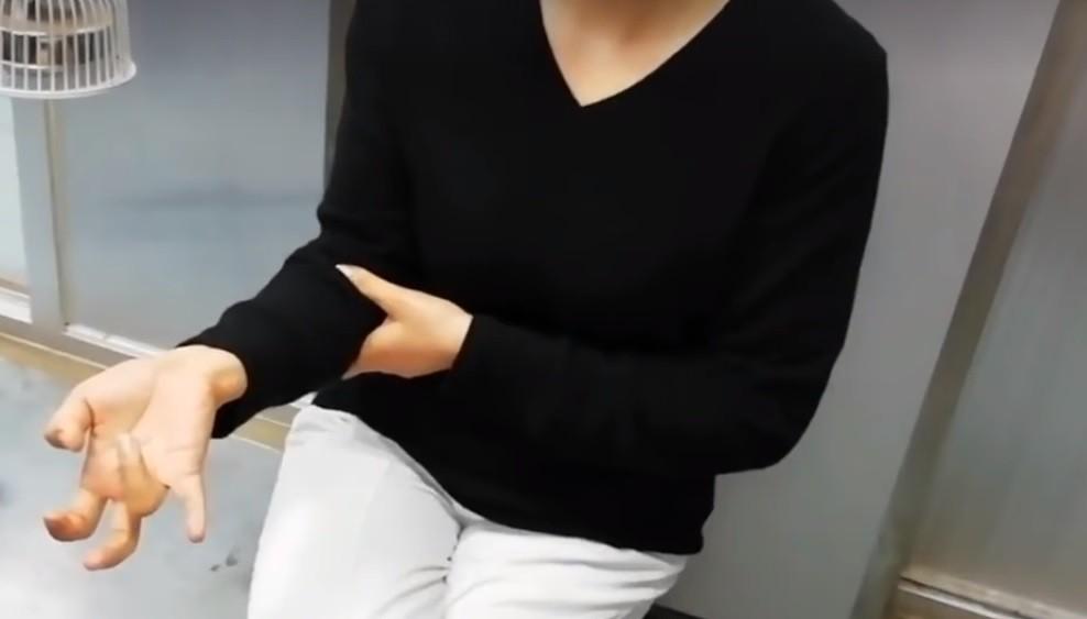 Após uso intenso do celular, mulher fica com os dedos paralisados