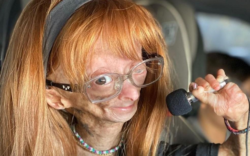 Morre aos 15 anos Adalia Rose, youtuber com ‘síndrome de Benjamin Button’ que tinha milhões de seguidores