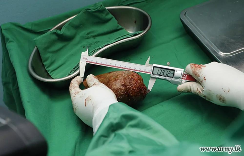 Médicos retiram de paciente a maior e mais pesada pedra no rim do mundo