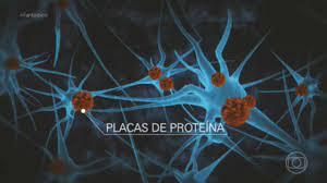 O que está acontecendo de mais moderno na pesquisa sobre o Alzheimer