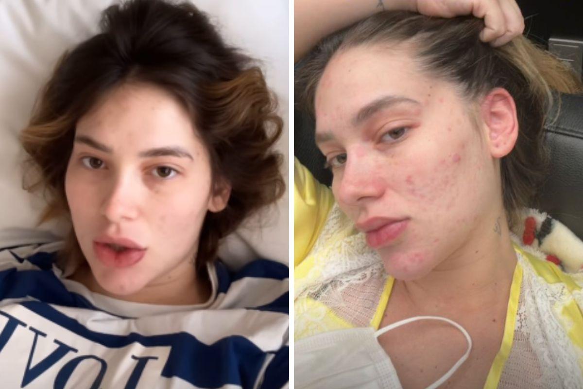 Virginia Fonseca tem piora em reação alérgica e é internada