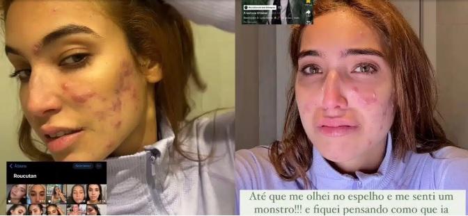 Vanessa Lopes desabafa sobre crise de acne e impacto na autoestima