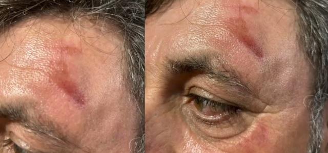 Uma coisa de cada vez: prefeito se distrai no celular, machuca testa e faz alerta