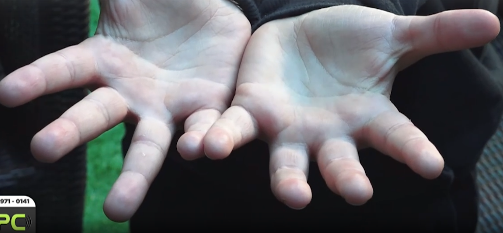 Alunos usam agulhas para furar colegas em escola municipal na região