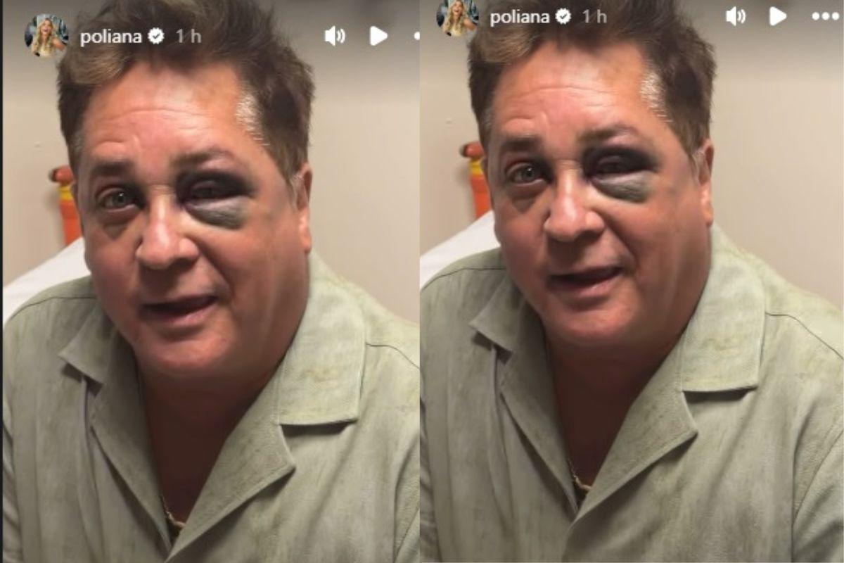 Leonardo surge com o olho roxo após acidente. Saiba o que aconteceu!